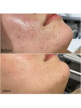 リブ(Lib)/本気の肌質改善トリートメント☆