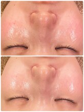 うつくし痩身 美サロン ゼットワン(Z-ONE)/カーボキシー小顔バンテージ