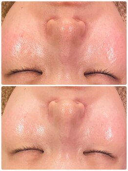 うつくし痩身 美サロン ゼットワン(Z-ONE)/カーボキシー小顔バンテージ