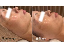 グレイス 高槻店(GRACE)/水光肌ピール3回目