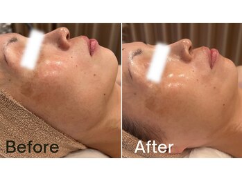 グレイス 高槻店(GRACE)/水光肌ピール3回目