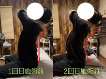 アポヨ鍼灸院(APOYO鍼灸院)/腰痛改善　before/after
