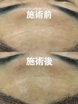 ツール(TOOL)/ハーブピーリング