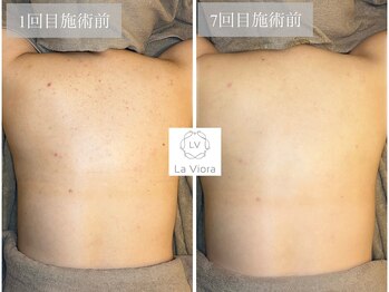 ラヴィオーラ 名駅(LaViora)/ダイヤモンドハーブピーリング