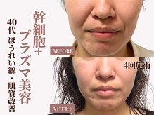 ベモーレ 谷町九丁目 上本町/50代プラズマ×幹細胞3回☆