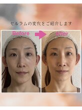 インフィニティ セルラム(INFINITY CELLULAM)/ビフォーアフター