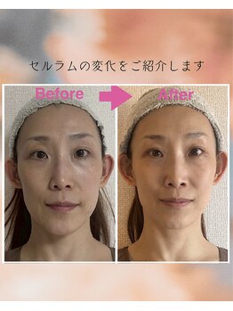 インフィニティ セルラム(INFINITY CELLULAM)/ビフォーアフター