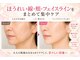 ラシクビューティールームの写真/40代からのほうれい線・たるみが気になる方へ