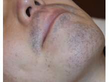 オアシスラグーン(OASIS LAGOON)/メンズ脱毛（症例３：before）