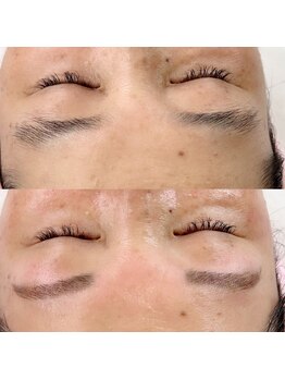 ビューティーリミ/フェイシャルワックス脱毛