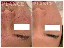 プランス 熊本(PLANCE)の雰囲気（知識豊富！エステ施術×スキンケアで自分史上最高の美肌へ）