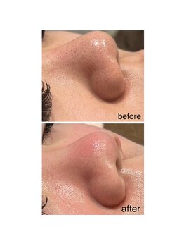 エステサロン ブレス 山形店(BLESS)/毛穴コース