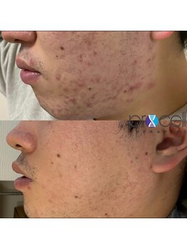 ブラジリアンワックス専門店 アンジー(ANGIE)/【清潔感UP】恋活婚活好感度UP！