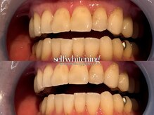 ココロビューティーギャラリー 武蔵小杉(cocorobeauty gallery)/5照射×2回セット♪