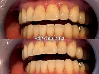 ココロビューティーギャラリー 武蔵小杉(cocorobeauty gallery)/5照射×2回セット♪