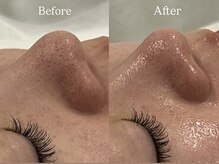 リフコウベ(LIF KOBE)/毛穴黒ずみ◇ハーブピーリング