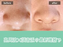 キザシ(kizashi)/最新毛穴ケア☆即実感！毛穴縮小