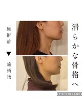 ミラクル(Miracle)/滑らかなフェイスラインへ♪