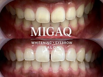 ミガク 京都四条大宮店(MIGAQ)の写真/歯の黄ばみ一気に改善！！