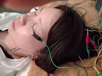 カンワ美容鍼灸院(KANWA美容鍼灸院)/眼精疲労は眼精疲労の鍼で一発！