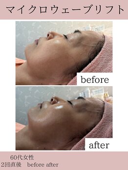 サロンドココ(Salon de COCO)/マイクロウェーブリフト