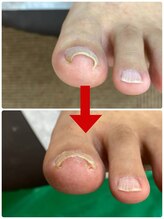 名古屋駅前巻き爪センター/巻き爪