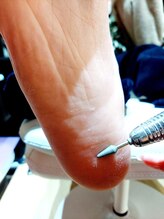 ソラ(sora)/夏に向けて、角質ケアでご来店♪