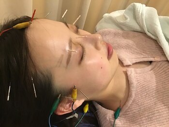 施術所ひびき庵/美容鍼でリフトアップ