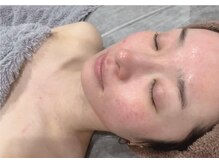 ベガ(Vega)/ハーブピーリングダウンタイム無