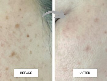 リンネ(Rin'ne)/プラズマ光フェイシャル　