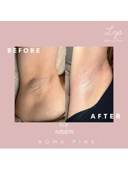 リスサロンドナース(LYS salon de Nurse)/ローマピンク