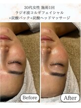 シーフェイス 横浜店(SEE FACE)/ラジオ波小顔コルギ+炭酸パック