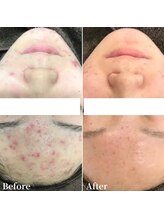 ニキビケア研究所 横浜店/おでこニキビでお悩みの方へ！