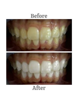 エクシアホワイトニング 相模大野店/ビフォーアフター