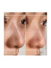 アクトウーマン(AKTWOMEN)/小鼻スペシャルケア