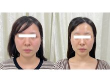 ワイサロン(Y salon)/【小顔症例】コルギ4回目