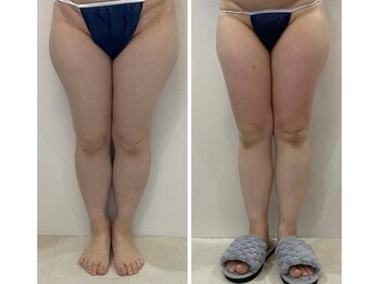 レミュ(Remu)/脂肪燃焼×セルライトゼロ