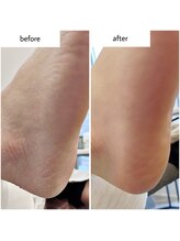 ケアプラス(care plus)/足裏角質ケア