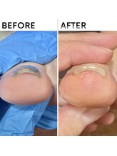 クオッカ(Quokka)/巻き爪ケア