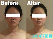 ビーキュート 学芸大学店(BE-CUTE)/Before/After　施術