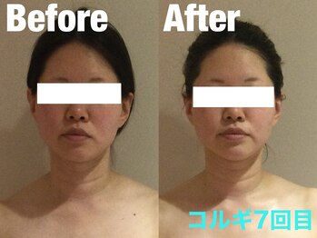 ビーキュート 学芸大学店(BE-CUTE)/Before/After 施術