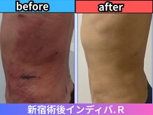 術後インディバ アール 新宿(R)の雰囲気（【腹部・腰部しぼう吸引】出血/硬さ/突っ張り/むくみ改善）