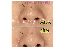 リッシュ(RICHE)/ハイドラ毛穴洗浄before→after