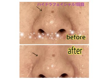 リッシュ(RICHE)/毛穴洗浄before→after