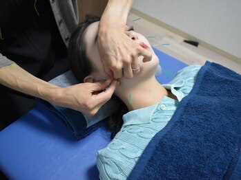 サロン ド ハリッシュ(Salon de HARISH)/美容鍼でキュッと小顔美人に♪