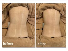 ラディアント(Radiant)/インディバ術後ケア/肌質改善