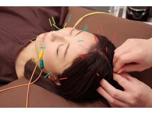 最終形美/痛みの少ない美容鍼灸◎