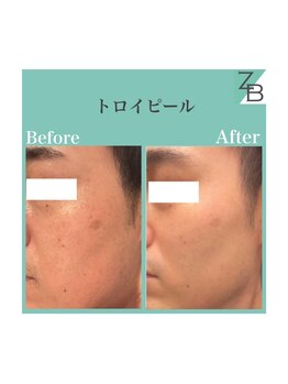 ザラハビューティー(ZARAHA Beauty)/トロイピール