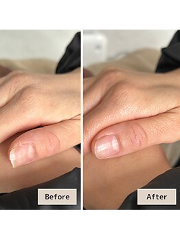 繰り返す爪割れや二枚爪対策に