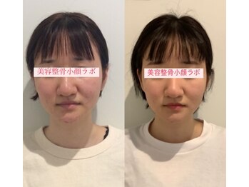 美容整骨小顔ラボ/小顔矯正ビフォーアフター